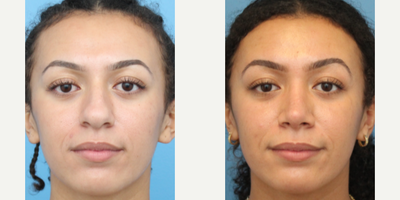 Case 3611 - Woman treated with Rhinoplasty