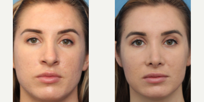 Case 3612 - Woman treated with Rhinoplasty