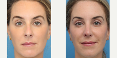 Case 3613 - Woman treated with Rhinoplasty