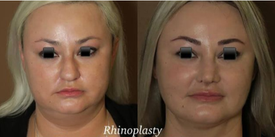 Case 3614 - Woman treated with Rhinoplasty