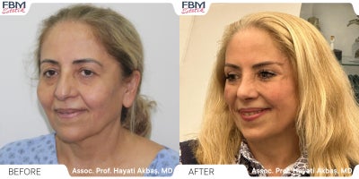 Case 3616 - 55-64 year old woman treated with Facelift, Neck Lift, Rhinoplasty, Double Eyelid Surgery