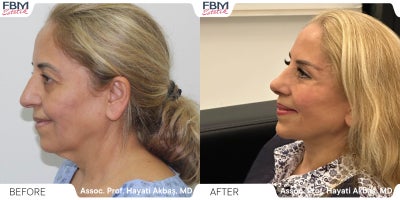 Case 3617 - 55-64 year old woman treated with Facelift, Neck Lift, Rhinoplasty, Double Eyelid Surgery