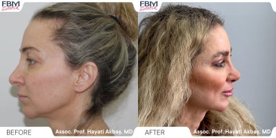 Case 3618 - 35-44 year old woman treated with Rhinoplasty, Facial Fat Transfer