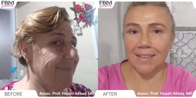 Case 3619 - 55-64 year old woman treated with Deep Plane Facelift, Neck Lift, Eyelid Surgery, Facial Fat Transfer, Rhinoplasty