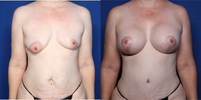 Case 362 - 35-44 year old woman treated with Tummy Tuck