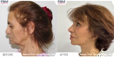 Case 3620 - 55-64 year old woman treated with Deep Plane Facelift, Neck Lift, Double Eyelid Surgery, Facial Fat Transfer, Rhinoplasty