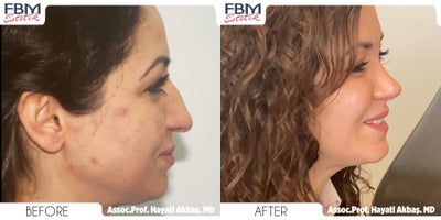 Case 3621 - 45-54 year old woman treated with Rhinoplasty, Chin Liposuction