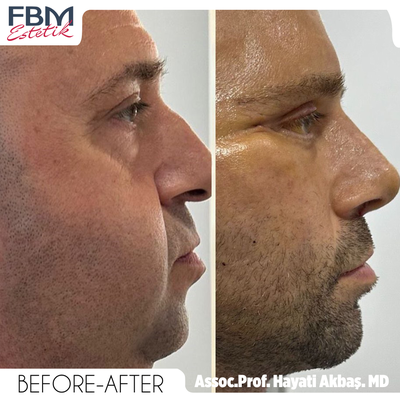 Case 3623 - 35-44 year old man treated with Lower Facelift, Eyelid Surgery, Rhinoplasty
