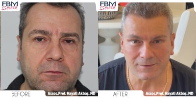 Case 3624 - 45-54 year old man treated with Deep Plane Facelift, Neck Lift, Alarplasty, Rhinoplasty, Eyelid Surgery, Facial Fat Transfer, Ha