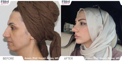 Case 3625 - 35-44 year old woman treated with Rhinoplasty, Facial Fat Transfer