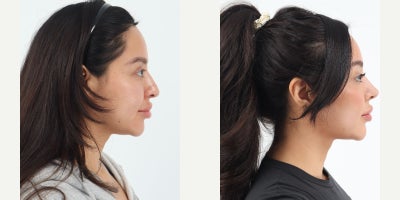 Case 3626 - 25-34 year old woman treated with Rhinoplasty