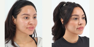 Case 3627 - 25-34 year old woman treated with Rhinoplasty