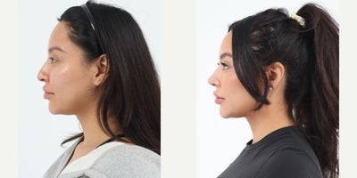 Case 3628 - 25-34 year old woman treated with Rhinoplasty