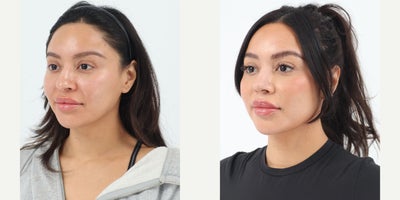 Case 3629 - 25-34 year old woman treated with Rhinoplasty