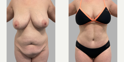 Case 363 - 45-54 year old woman treated with Tummy Tuck