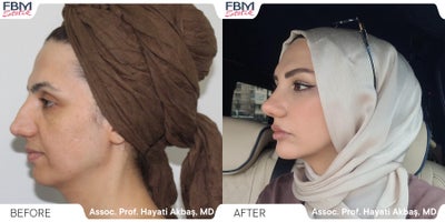 Case 3630 - 35-44 year old woman treated with Rhinoplasty