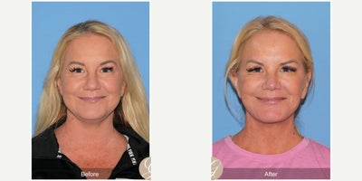 Case 3631 - 55 year old woman treated with Deep Plane Facelift, Facelift, Lower Facelift, Neck Lift, Buccal Fat Removal, Eyelid Surgery, Rhi