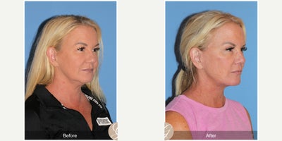 Case 3632 - 55 year old woman treated with Deep Plane Facelift, Facelift, Lower Facelift, Neck Lift, Buccal Fat Removal, Eyelid Surgery, Rhi