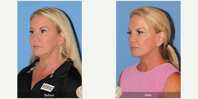 Case 3633 - 55 year old woman treated with Deep Plane Facelift, Facelift, Lower Facelift, Neck Lift, Buccal Fat Removal, Eyelid Surgery, Rhi