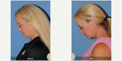 Case 3634 - 55 year old woman treated with Deep Plane Facelift, Facelift, Lower Facelift, Neck Lift, Buccal Fat Removal, Eyelid Surgery, Rhi