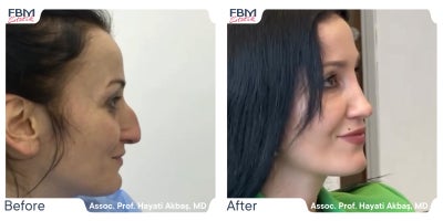 Case 3635 - 55-64 year old woman treated with Facial Fat Transfer, Rhinoplasty