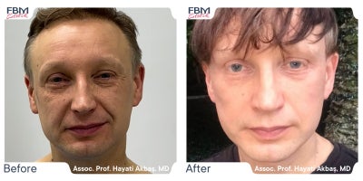Case 3636 - 55-64 year old man treated with Facelift, Deep Plane Facelift, Rhinoplasty, Facial Fat Transfer