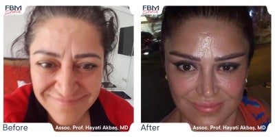 Case 3637 - 45-54 year old woman treated with Deep Plane Facelift, Facelift, Eyelid Surgery, Rhinoplasty, Facial Fat Transfer