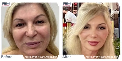 Case 3638 - 45-54 year old woman treated with Deep Plane Facelift, Facial Fat Transfer, Rhinoplasty, Eyelid Surgery