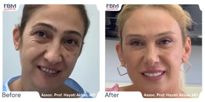 Case 3639 - 45-54 year old woman treated with Deep Plane Facelift, Rhinoplasty, Eyelid Surgery, Facial Fat Transfer