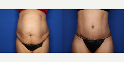Case 364 - 35-44 year old woman treated with Tummy Tuck