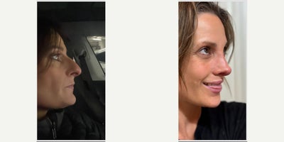 Case 3640 - 45-54 year old woman treated with Rhinoplasty