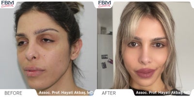 Case 3641 - 25-34 year old woman treated with Rhinoplasty, Facial Fat Transfer, Eyelid Surgery