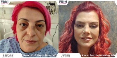 Case 3642 - 45-54 year old woman treated with Facelift, Deep Plane Facelift, Facial Fat Transfer, Eyelid Surgery, Lip Lift, Rhinoplasty, Nec