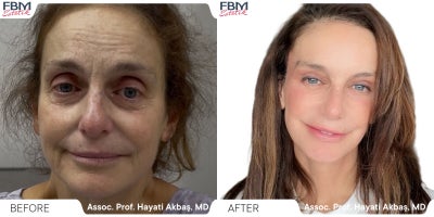 Case 3643 - 55-64 year old woman treated with Deep Plane Facelift, Facelift, Neck Lift, Rhinoplasty, Facial Fat Transfer, Eyelid Surgery