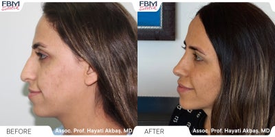 Case 3644 - 25-34 year old woman treated with Rhinoplasty, Facial Fat Transfer