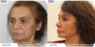 Case 3645 - 65-74 year old woman treated with Facelift, Deep Plane Facelift, Neck Lift, Facial Fat Transfer, Eyelid Surgery, Rhinoplasty