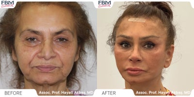 Case 3646 - 65-74 year old woman treated with Deep Plane Facelift, Facelift, Facial Fat Transfer, Eyelid Surgery, Rhinoplasty, Neck Lift