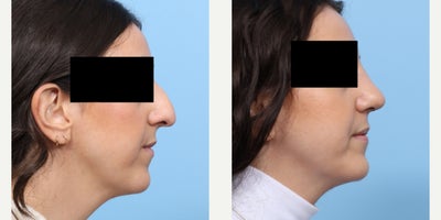 Case 3647 - 25-34 year old woman treated with Rhinoplasty