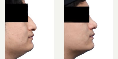 Case 3649 - 18-24 year old man treated with Rhinoplasty