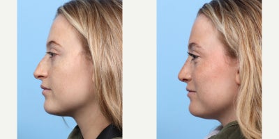 Case 3650 - 18-24 year old woman treated with Rhinoplasty