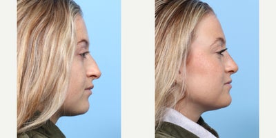 Case 3651 - 18-24 year old woman treated with Rhinoplasty