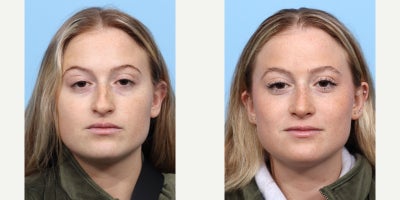 Case 3652 - 18-24 year old woman treated with Rhinoplasty