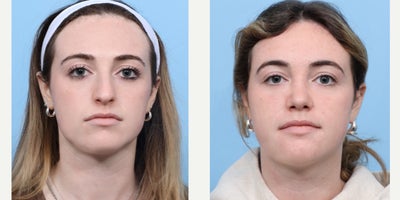 Case 3653 - 18-24 year old woman treated with Rhinoplasty