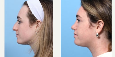 Case 3654 - 18-24 year old woman treated with Rhinoplasty