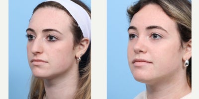 Case 3655 - 18-24 year old woman treated with Rhinoplasty