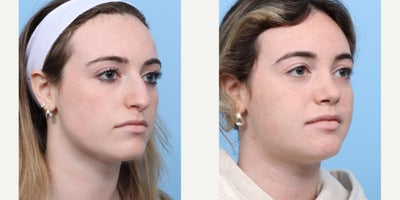 Case 3656 - 18-24 year old woman treated with Rhinoplasty