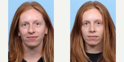 Case 3657 - 18-24 year old woman treated with Rhinoplasty