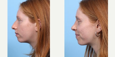 Case 3658 - 18-24 year old woman treated with Rhinoplasty