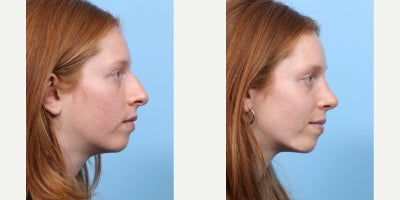 Case 3659 - 18-24 year old woman treated with Rhinoplasty