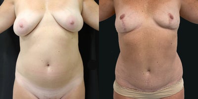 Case 366 - 45-54 year old woman treated with Tummy Tuck